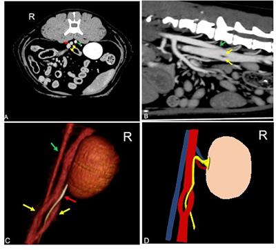 Computed tomographic appearance of transcaval ureter in two dogs and three cats: A novel CVC congenital malformation